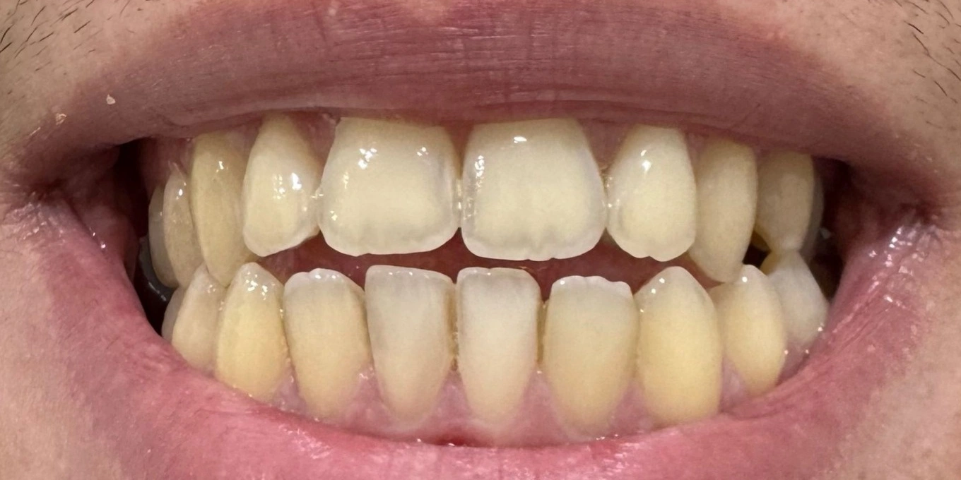 Branqueamento dentário — antes do tratamento